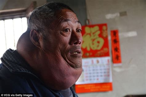Man With Growth Of Fat On Neck Makes Plea For Help Daily Mail Online