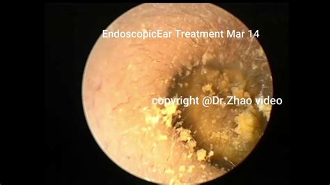 Satisfying Ear Wax Removal Extration With Dr Zhao Video 12 Minutes