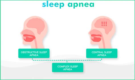 main types  sleep apnea explainedobstructive central