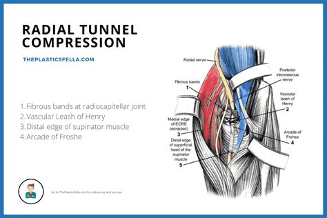 radial nerve tunnel syndrome