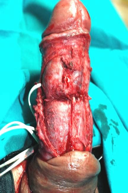 penis inside male urethra