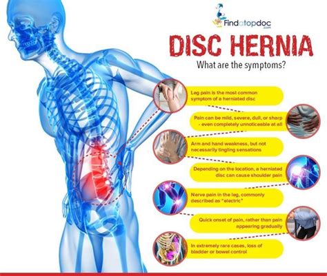 what are the symptoms of disc hernia [infographic]