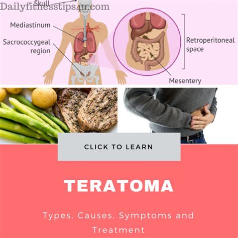 teratoma types causes symptoms and treatment