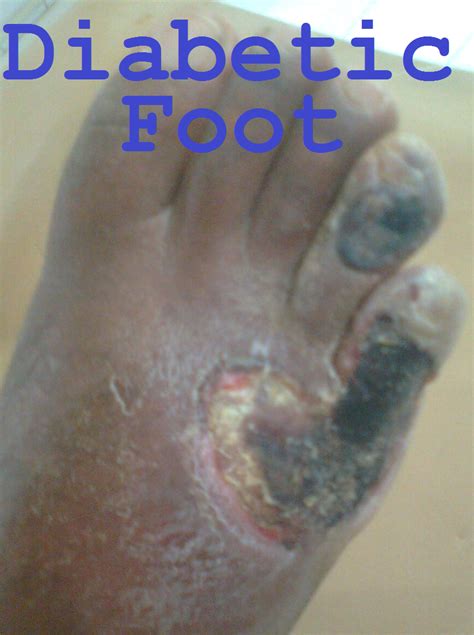 Diabetic Foot Infection A Major And Dangerous
