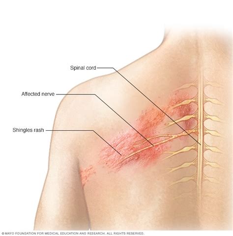 shingles symptoms   mayo clinic