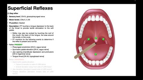 Gag Reflex Procedure And Results Interpretation Youtube