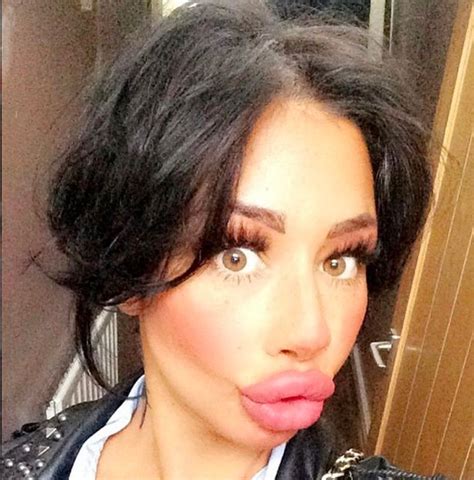 This Lady Whos Had £1 600 Worth Of Lip Fillers Wants To Go Even Bigger