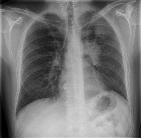 persistent hypokalaemia  abnormal chest radiography european respiratory society