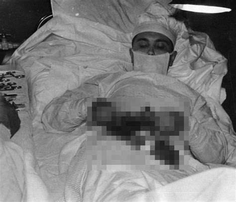 leonid rogozov the russian surgeon who removed his own appendix