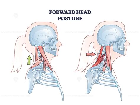 head posture compared  healthy neck position outline