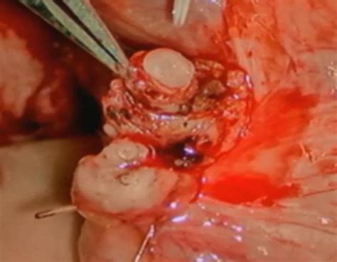 vasectomy reversal uc davis health department of urologic surgery