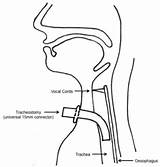 Tracheostomy Bmj sketch template