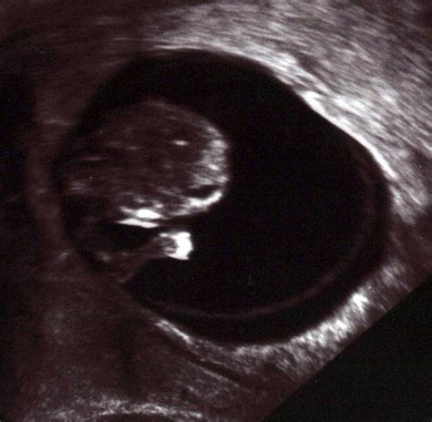 Fehlgeburten Jede Dritte Schwangerschaft Endet Mit Dem Abort Welt