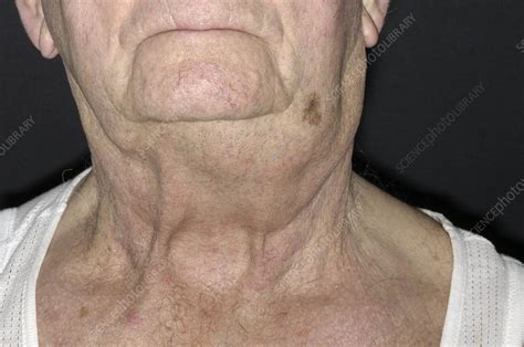 swollen lymph nodes  neck