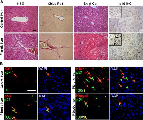senescence  activated stellate cells limits liver fibrosis cell