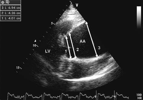 aneurysm   ascending aorta heart