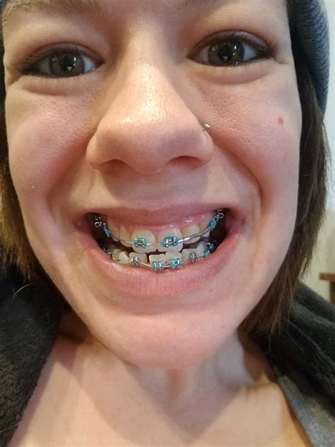 Adult Braces Anyone Else Find It Weird Relearning How To Smile After