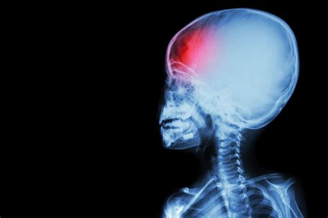 signs  symptoms  concussions