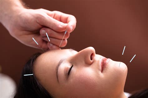 acupuncture for migraine headaches alleviant heath centers