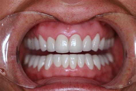 tmj bite correction full mouth rehabilitation in glastonbury ct full