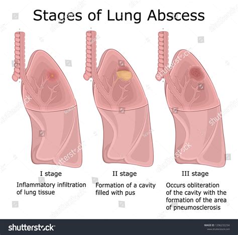 Illustration Three Stages Pulmonary Disease Lung Stock Vector Royalty