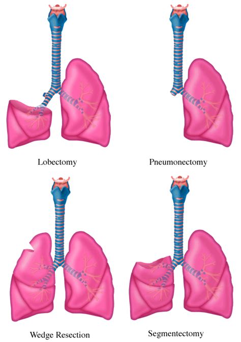 lobectomy pneumonectomy wedge resection segmentectomy surgery