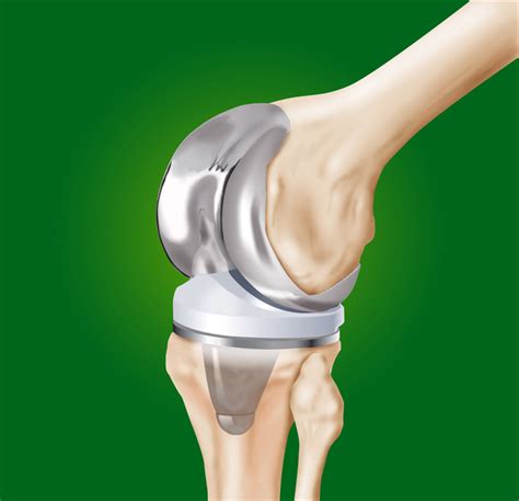 knieprothese letztes mittel bei schwerer kniearthrose