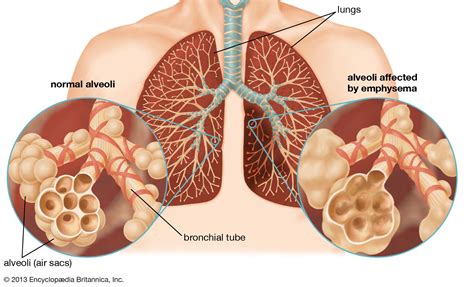 Respiratory Disease Definition Causes And Major Types Britannica