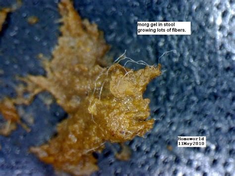 morgellons disease awareness morgellons fibers in stoolphotos and