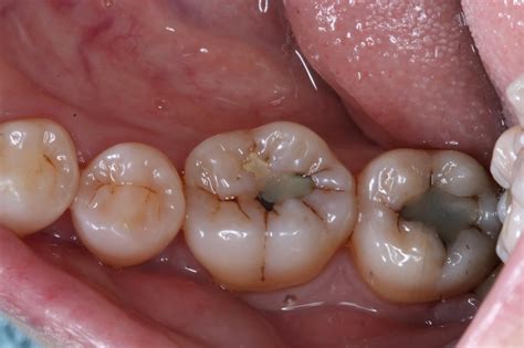 dental cavity molar