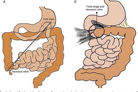 figure   intestinal malrotation volvulus imaging findings semantic scholar