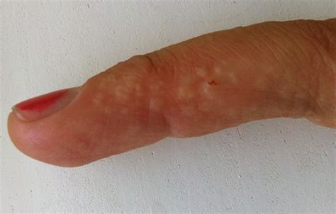 causes of dyshidrotic eczema pictures photos