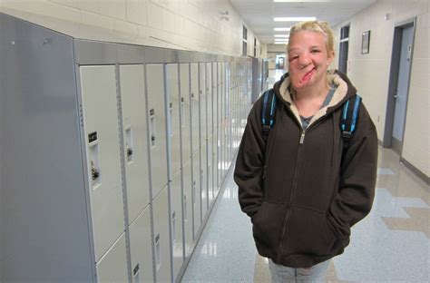 The Girl With Half A Face Teen With Rare Facial Deformity Opens Up