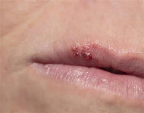 stop  cold sore   early stages