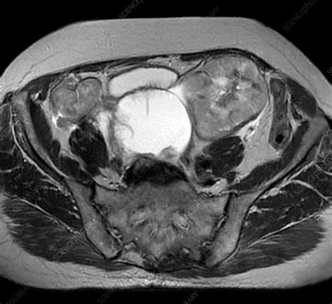 bilateral ovarian cancer mri scan stock image  science photo library