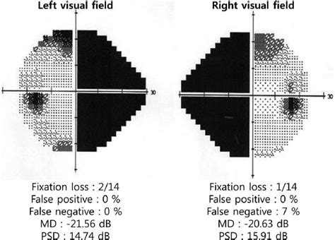 visual field    humphrey automated perimetry