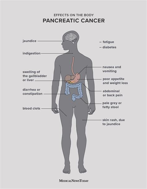Pancreatic Cancer Symptoms Causes And Treatment