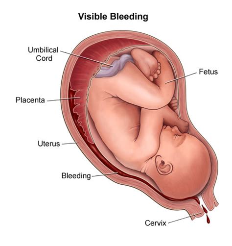 pregnant bleeding cramping tubezzz porn photos