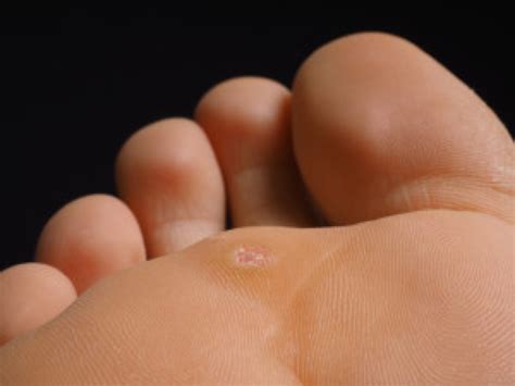 summer foot care plantar warts   avoid treat