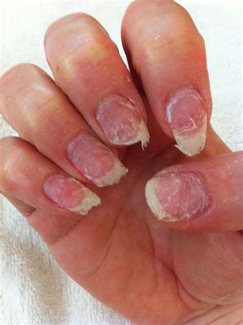 occur  moisture collects  acrylic nails    common  nails