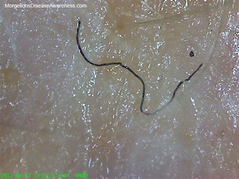 pin on morgellons