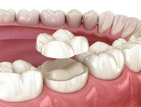 dental inlays onlays  damaged teeth green dental  lyons