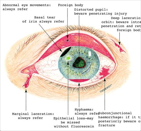 injury   eye  bmj