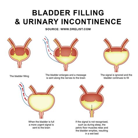 urinary incontinence image … urinary incontinence incontinence stress incontinence