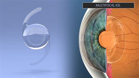 advanced technology intraocular lenses  eye mds