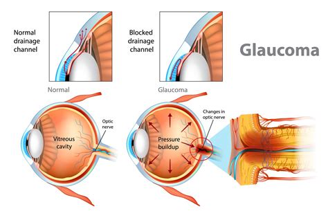 glaucoma informationadvice  glaucoma focus medical eye centre