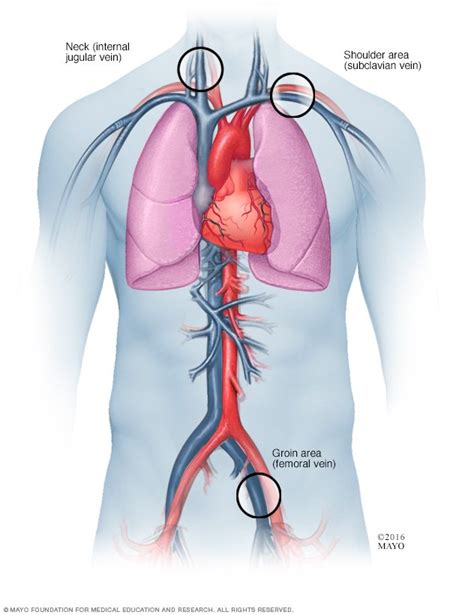 Cardiac Ablation