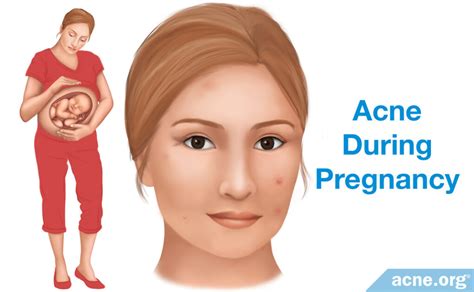 Does Pregnancy Cause Acne