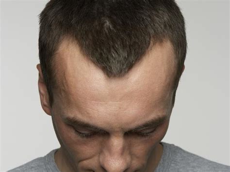 Hair Loss Explained How And Why Men Go Bald The Independent