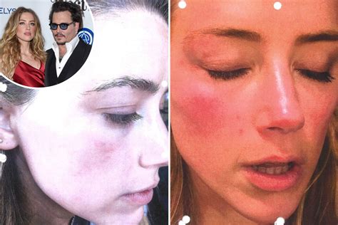 new pictures show amber heard s bruised face after johnny depp threw